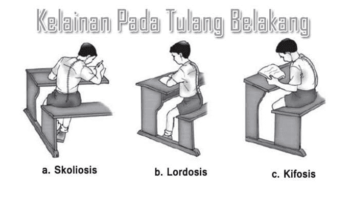 Kelainan Pada Tulang Belakang a. Skoliosis b. Lordosis c. Kifosis 