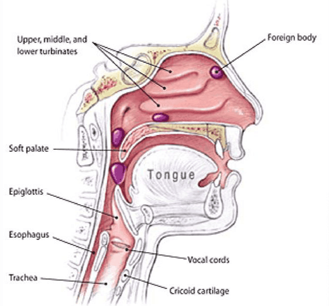 Foreign body Upper middle and lower turbinates Soft palate Tongue Epiglottis Esophagus -Vocal cords Trachea Cricold cartilage 