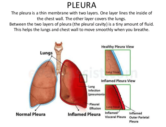 PLEURA The pleura is a thin membrane with two layers. One layer lines the inside of the chest wall. The other layer covers the lungs. Between the two layers of pleura (the pleural cavity) is a tiny amount of fluid. This helps the lungs and chest wall to move smoothly when you breathe. Healthy Pleura View Lungs Lung Tissue Inflamed Pleura View -Lung Infection (pneumonia Pleural Effusion Inflamed Pleura Normal Pleura Lung Tissot Inflamed Inflamed Visceral Pleura Outer Parietal Pleura 