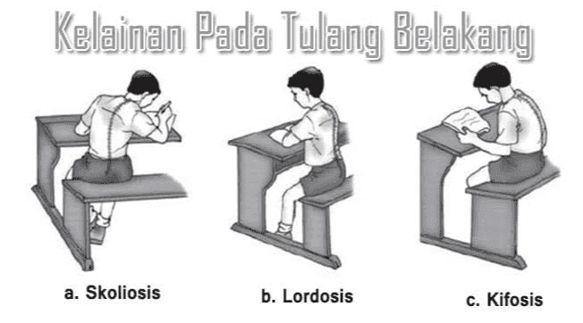 Kelainan Pada Tulang Belakang a. Skoliosis b. Lordosis c. Kifosis 