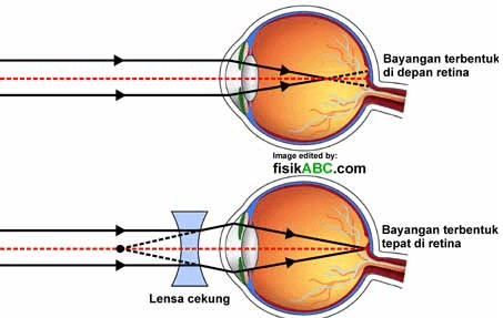 Bayangan terbentuk di depan retina Image edited by: fisikABC.com Bayangan terbentuk tepat di retina Lensa cekung 