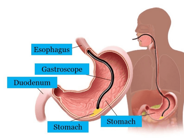IN 
Esophagus Gastroscope Duodenum Stomach Stomach 
