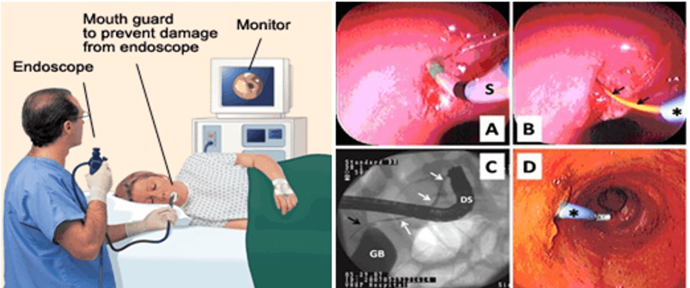 Monitor Mouth guard to prevent damage from endoscope Endoscope AB i Taru cID DS GB 