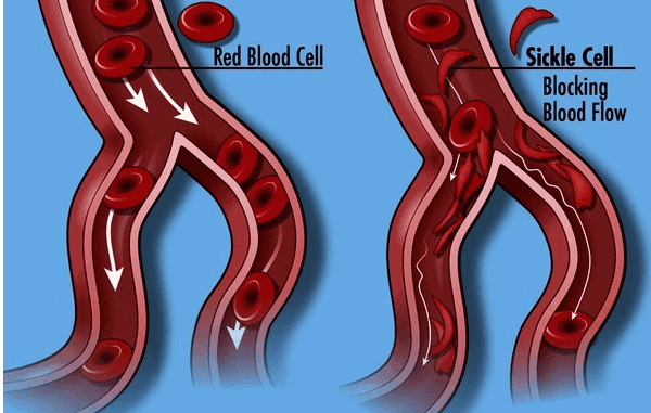 Do Red Blood Cell Olo Sickle Cell Blocking Blood Flow 