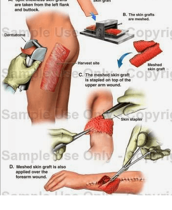 are taken from the left flank and buttock B. The skin grafts are meshed come le US Dermatome copyric Meshed skin graft Jan -Harvest site C. The meshed skin gratt is stapled on top of the upper arm wound. grante o programie Sample te sien stopher pyrig Sample Use Only D. Meshed skin graft is also applied over the forearm wound. 