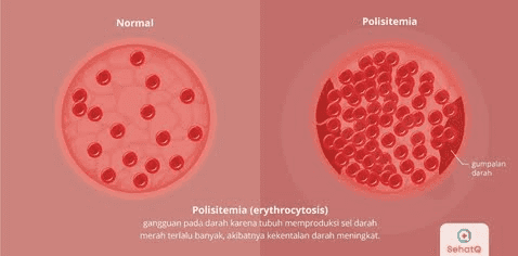 Normal Polisitemia sumpatan darah Polisitemia (erythrocytosis) gangguan pada darah karena tubuh memproduksi sel darah merah terlalu banyak, akibatrya kekentalan darah meningkat. Sehata 
